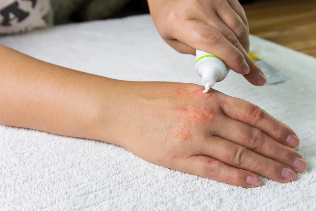 applying-ointment-emollient-cream-treatment-hydration-skin.webp-1-1024×683