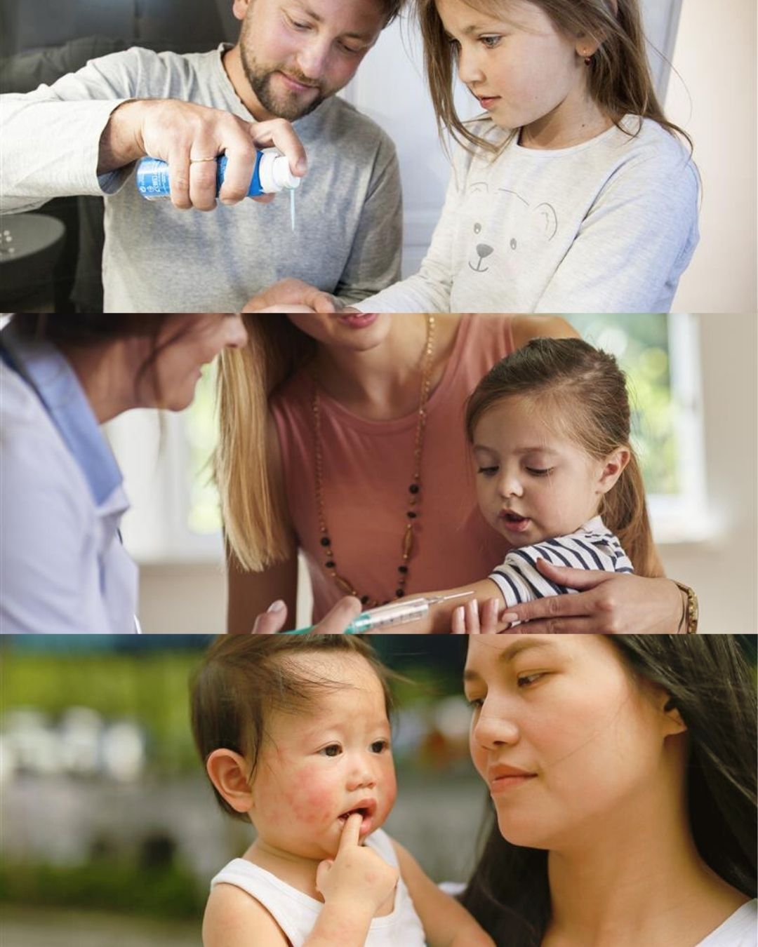 eczema in children
